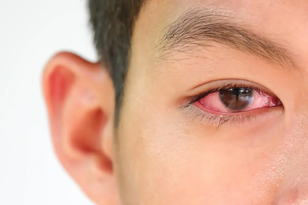 Bệnh đau mắt đỏ: Triệu chứng, Nguyên nhân & Phòng ngừa