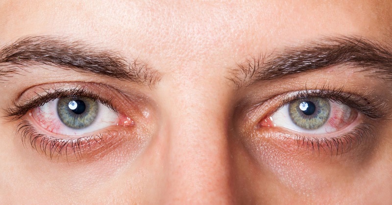 Phương pháp điều trị viêm kết mạc mắt là gì?